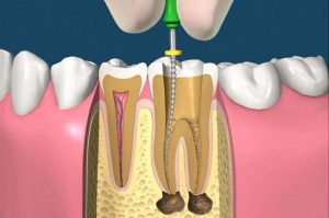 endodonzia